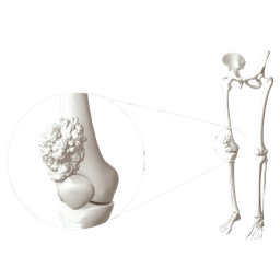 Bone Cancer