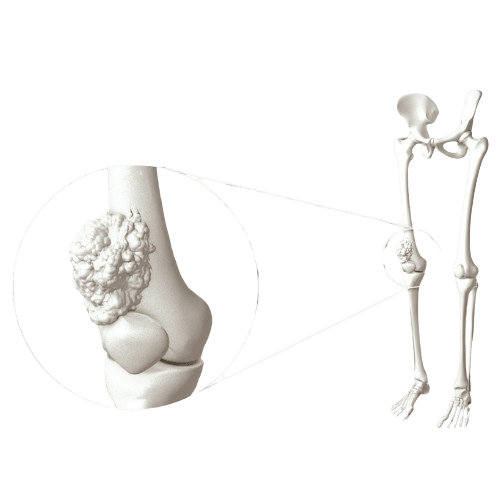 Bone Cancer