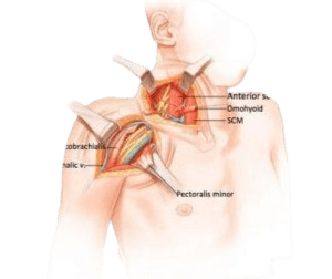 Brachial Plexus Surgery