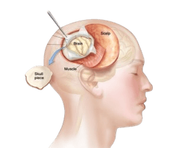 Brain Tumour Surgery