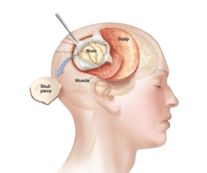 Brain Tumour Surgery