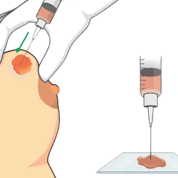 Breast Biopsy