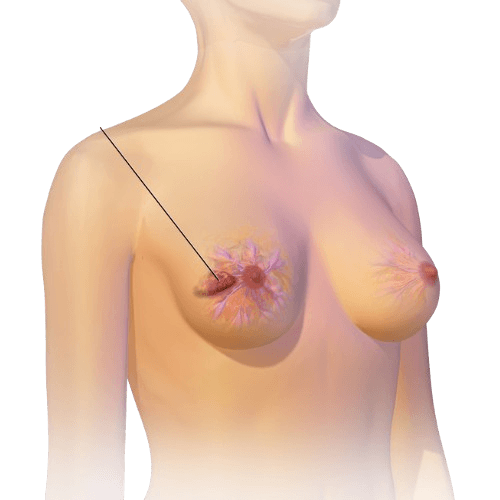 Breast Cancer Surgery
