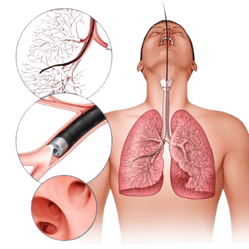 Bronchoscopy