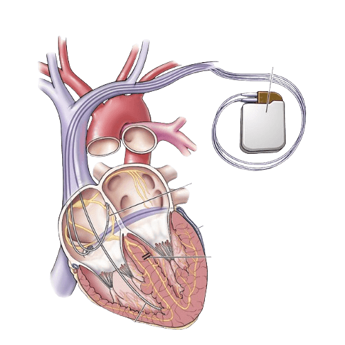 Cardiac Resynchronization Therapy (CRT-D Implant)