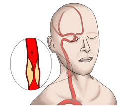 Carotid Artery Stenosis