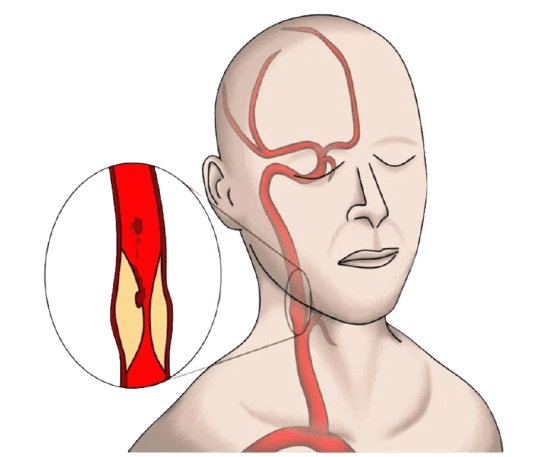 Carotid Artery Stenosis