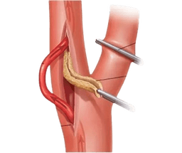 Carotid Endarterectomy