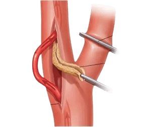 Carotid Endarterectomy
