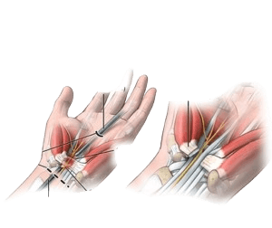 Carpal Tunnel Release Open or Endoscopic-CTR