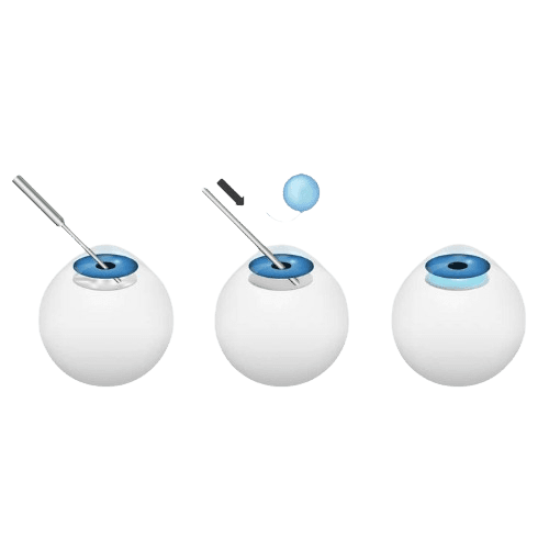 Cataract Implant Surgery