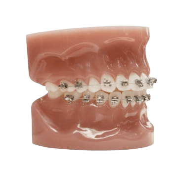 Ceramic Braces