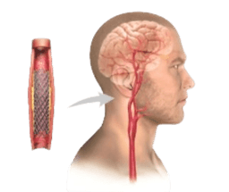 Cerebral Angioplasty