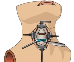 Cervical Spine Surgery