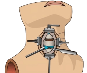 Cervical Spine Surgery