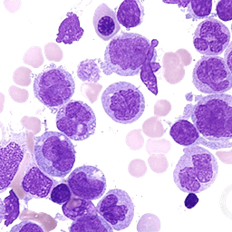 Chronic Myelomonocytic Leukemia