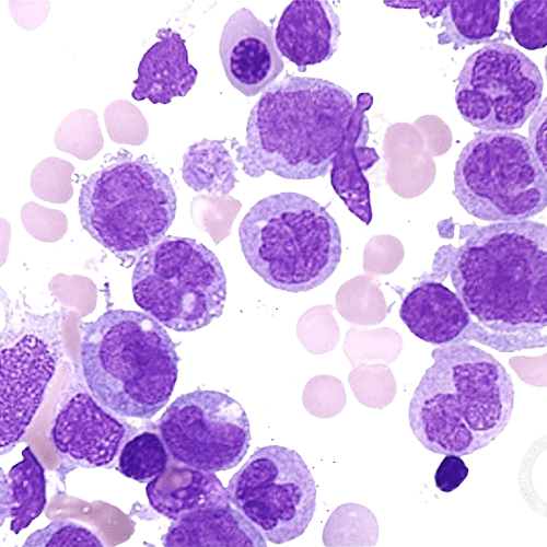 Chronic Myelomonocytic Leukemia