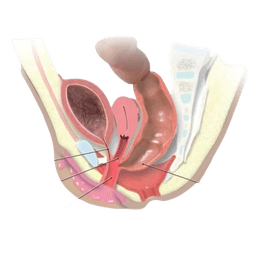 Cloacal Malformation Surgery