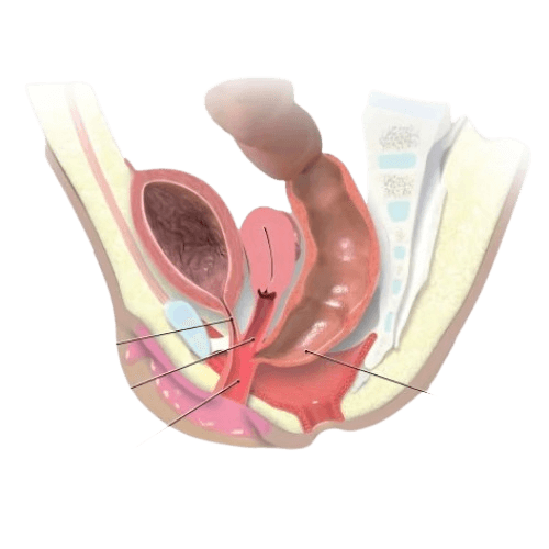 Cloacal Malformation Surgery