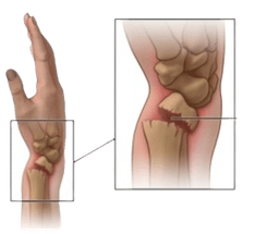 Closed Reduction Fracture