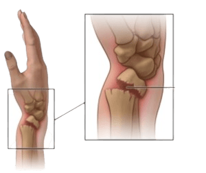 Closed Reduction Fracture