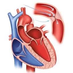 Coarctation of the Aorta Surgery-CoA