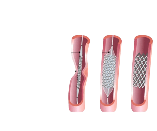 Коарктационное стентирование