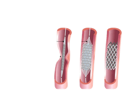 Coarctation Stenting