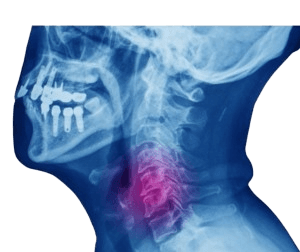 Comprehensive Myelopathy - Spinal Cord Surgery
