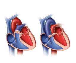 Congenital Heart Surgeries