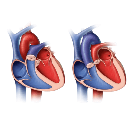 Congenital Heart Surgeries