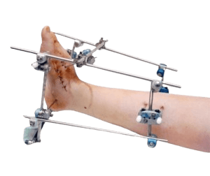 Congenital Limb Defects Correction Surgery