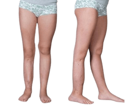 Congenital Pseudarthrosis of the Tibia Surgery-CPT