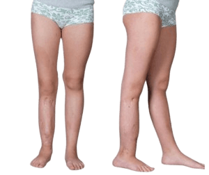 Congenital Pseudarthrosis of the Tibia Surgery-CPT