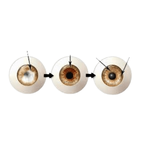 Corneal Transplantation - Eye Transplant