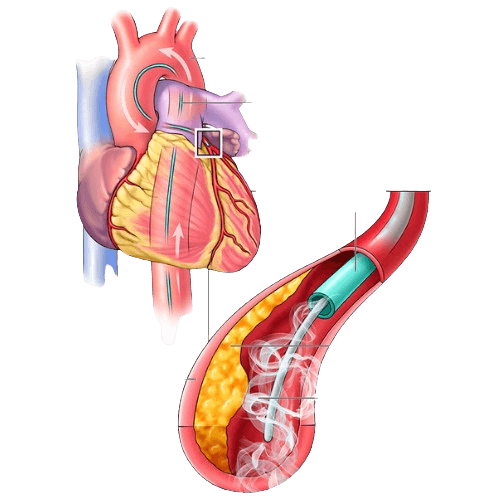 Coronary Angiogram