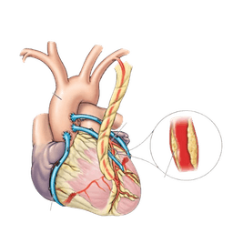 Coronary Artery Bypass Surgery (CABG)
