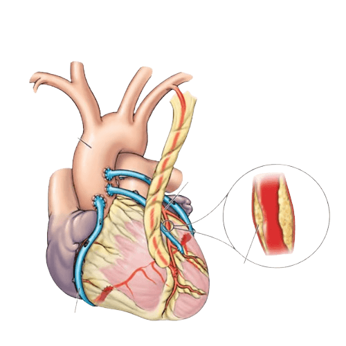 Coronary Artery Bypass Surgery (CABG)