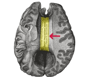 Corpus Callosotomy