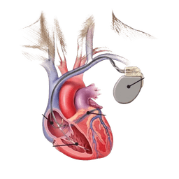 CRT-D Implant
