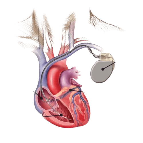 CRT-D Implant