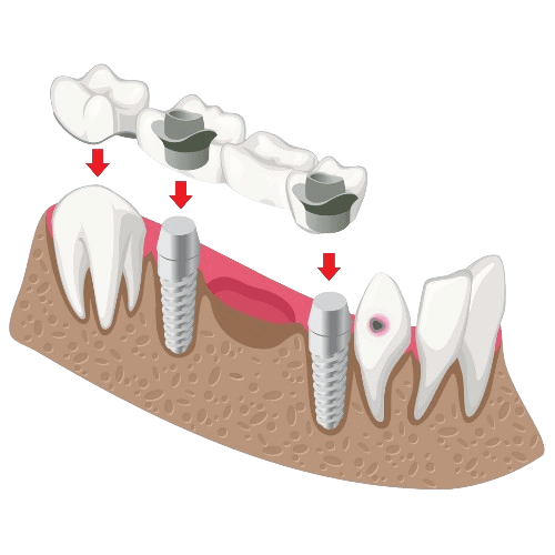Dental Crowns - Dental Cap