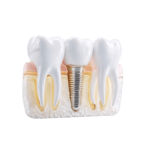 Dental Inlays & Onlays