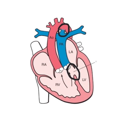 Double Outlet Right Ventricle (DORV)