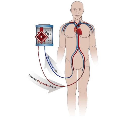 ECMO Support