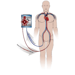 ECMO Support