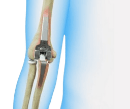 Elbow Replacement Surgery