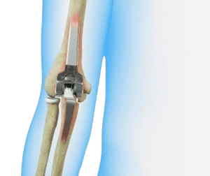 Elbow Replacement Surgery