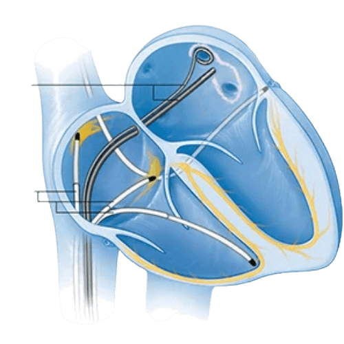 Electrophysiological Study (EPS)