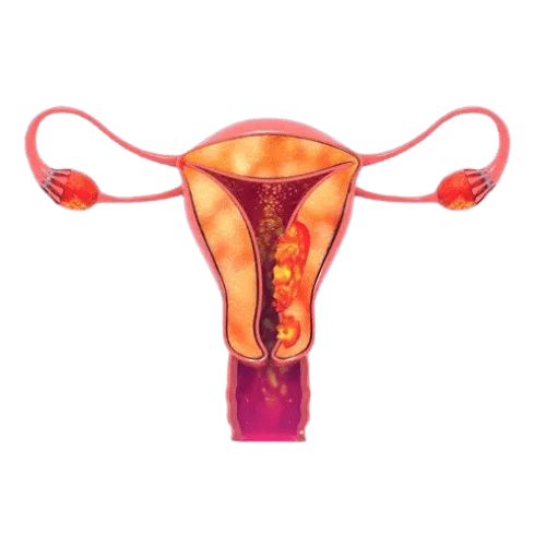 Endometrial Cancer
